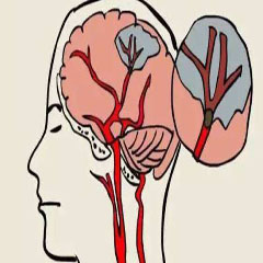 有危害的的脑血管病要早重视