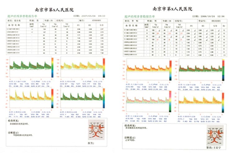 KJ-2V4M经颅多普勒检测报告 KJ-2V4M经颅多普勒检测报告