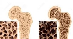 骨密度仪厂家介绍：补钙防治骨密度的误区有哪些?