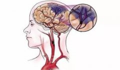 了解脑卒中危险因素及时检查