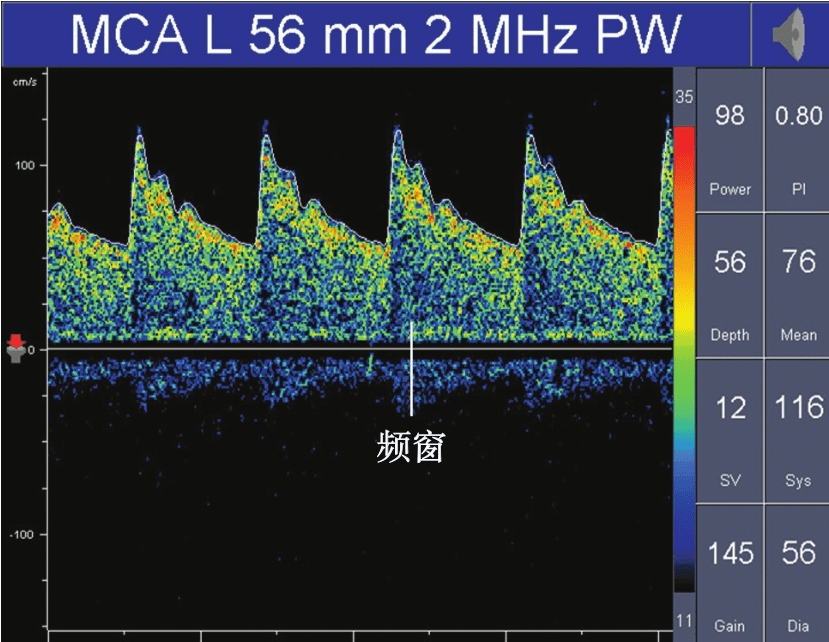 TCD多普勒正常血流频谱可见频窗