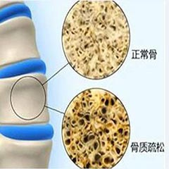 【骨密度分析仪科普】骨密度指标对照表，人手一份