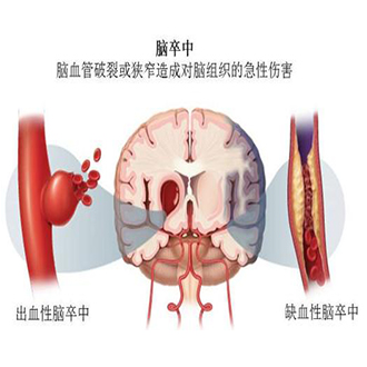 检查脑卒中不要怕-经颅多普勒看透你的脑