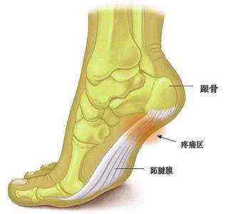 跟骨疼痛需谨慎骨密度