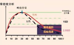 骨密度难防又难治 科学补钙讲究方法