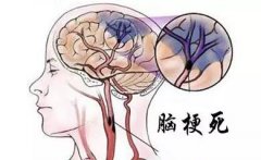 脑血管疾病脑梗的相关知识详解