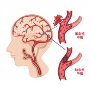 了解脑血管病的防治策略