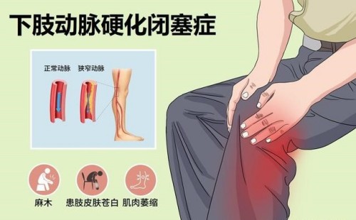 动脉硬化