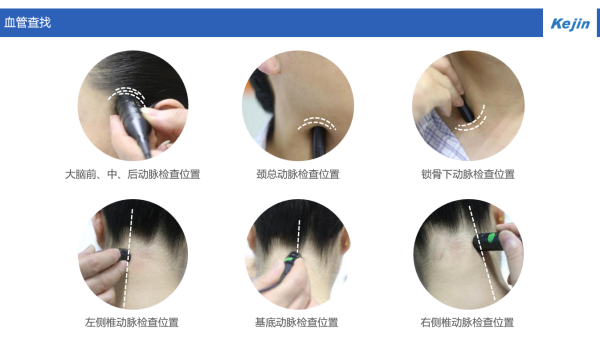 超声经颅多普勒